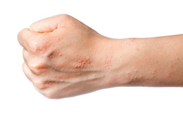 Fight Eczema Naturally!